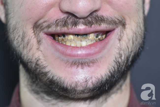 Chàng trai Mỹ 27 năm 'không dám cười' vì mang căn bệnh di truyền khiến răng luôn ố vàng hư hỏng nặng - Ảnh 2.
