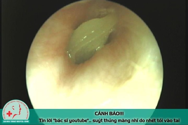 Tin lời "bác sĩ youtube" nam thanh niên suýt thủng mảng nhĩ vì nhét tỏi vào tai chữa bệnh - Ảnh 1. Tin lời "bác sĩ youtube" nam thanh niên suýt thủng mảng nhĩ vì nhét tỏi vào tai chữa bệnh - Ảnh 1.