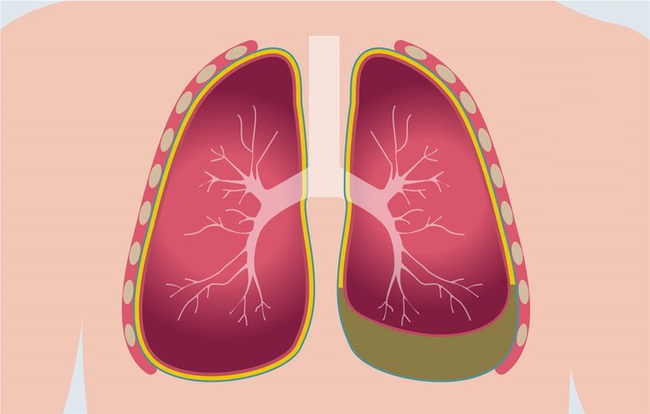 Phổi trái của cô gái 24 tuổi đã bị co lại 30%, chỉ vì đã làm điều này - Ảnh 3.