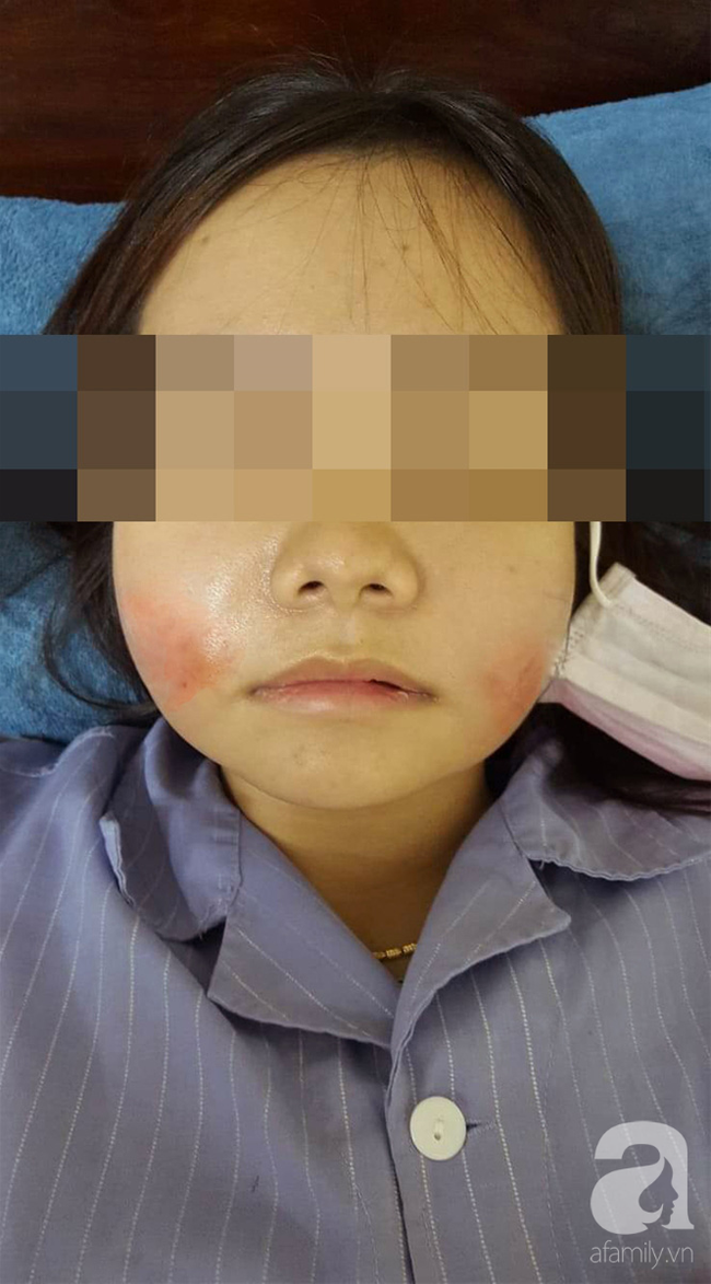 Nhiều người gặp biến chứng do tiêm filler trẻ hóa khuôn mặt, chuyên gia cảnh báo cần hết sức cẩn trọng - Ảnh 1.