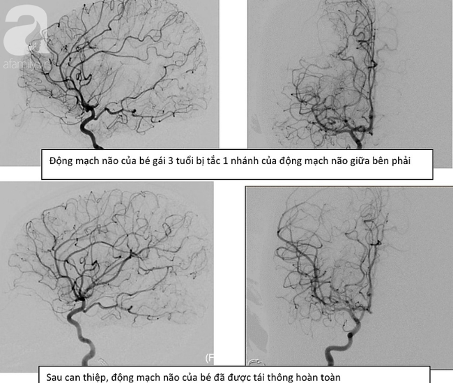 Bé gái 3 tuổi liệt nửa người nguy kịch vì đột quỵ nhồi máu não nhưng bị bệnh viện địa phương chẩn đoán nhầm - Ảnh 3.
