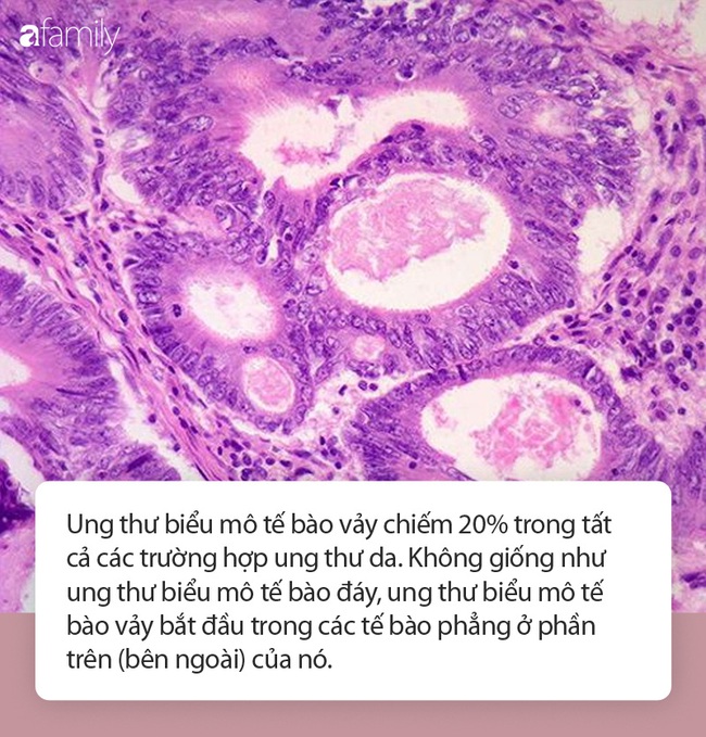 Kinh hãi chiếc &quot;sừng rồng&quot; trên lưng người đàn ông - hệ quả của ung thư biểu mô tế bào vảy - Ảnh 3.