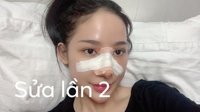 Câu chuyện “rùng rợn” về cô gái nâng mũi 4 lần đến mức hết sạch sụn tai, từng trầm cảm, muốn chết vì phẫu thuật hỏng - Ảnh 3. Câu chuyện “rùng rợn” về cô gái nâng mũi 4 lần đến mức hết sạch sụn tai, từng trầm cảm, muốn chết vì phẫu thuật hỏng - Ảnh 3.