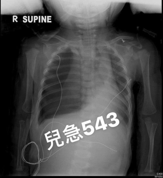 Hóc xương cá: Bé hóc xương cá dẫn đến rách thực quản vì món cháo cá - Ảnh 2.