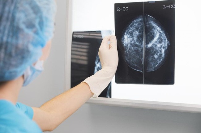 Mỹ: tỷ lệ tử vong do ung thư vú giảm đến hơn 50% vào năm 2018, chúng ta học được điều gì từ đây? - Ảnh 1.