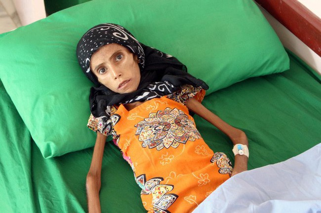 Bé gái 12 tuổi da bọc xương trở thành biểu tượng đầy ám ảnh của cuộc chiến tại Yemen - Ảnh 1.