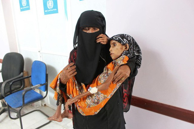 Bé gái 12 tuổi da bọc xương trở thành biểu tượng đầy ám ảnh của cuộc chiến tại Yemen - Ảnh 2.