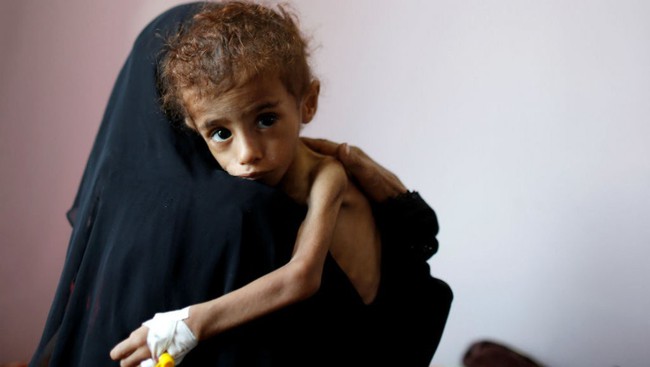 Bé gái 12 tuổi da bọc xương trở thành biểu tượng đầy ám ảnh của cuộc chiến tại Yemen - Ảnh 3.