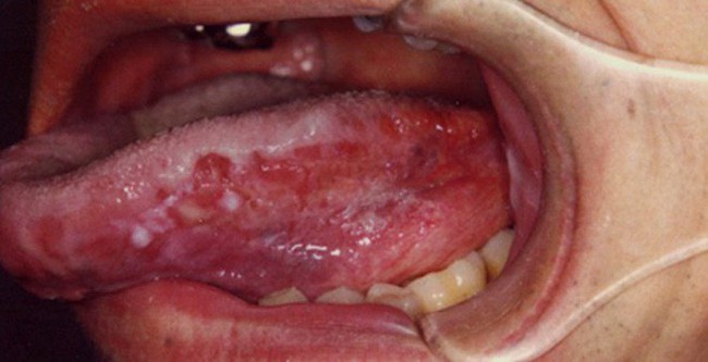Dấu vết lạ trên lưỡi người đàn ông này hóa ra là một dạng ung thư hiếm gặp - Ảnh 4.