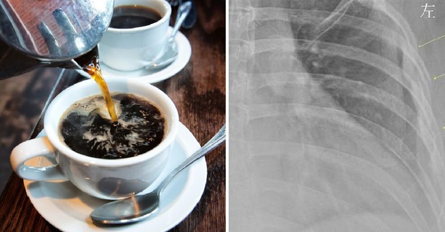 Người phụ nữ 30 tuổi này đã uống 10 tách cà phê mỗi ngày và bác sĩ đã sửng sốt khi nhìn kết quả X-quang của cô - Ảnh 1.