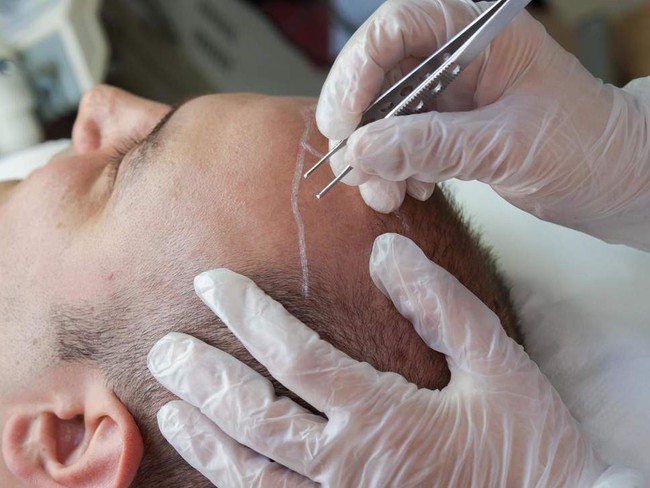 Chi gần 200 triệu đồng để cấy tóc chữa hói đầu, doanh nhân Ấn Độ chết thảm vì dị ứng - Ảnh 1.