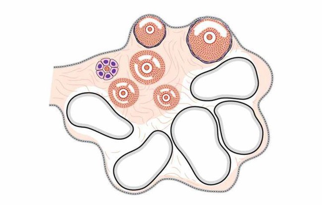 Những người có nguy cơ mắc xoắn buồng trứng? - Ảnh 1.