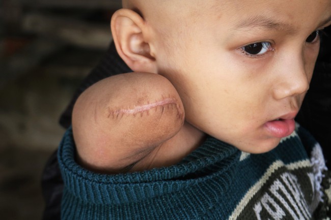 Lời cầu xin của bé trai 5 tuổi bị ung thư xương bên người anh bại não: “Con chỉ còn một tay thôi, mẹ xin bác sĩ đừng cắt của con đi - Ảnh 2.