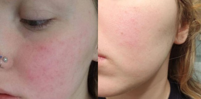 6 mặt nạ lạ tai nhưng lại trị mụn, dưỡng da cực đỉnh, thú vị nhất là loại zombie khiến bạn xấu xí trước khi đẹp lên - Ảnh 10. 6 mặt nạ lạ tai nhưng lại trị mụn, dưỡng da cực đỉnh, thú vị nhất là loại zombie khiến bạn xấu xí trước khi đẹp lên - Ảnh 10.