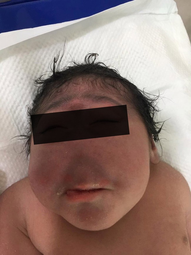 Ca sinh nở hiếm gặp: Em bé chào đời hoàn toàn không có mũi khiến bác sĩ cũng kinh ngạc vì chưa gặp bao giờ - Ảnh 1.