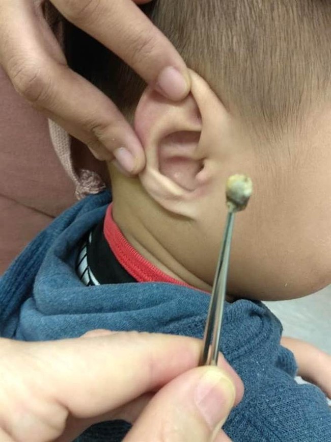 Bé trai 3 tuổi bỗng nhiên mất thính lực, đến khi bác sĩ lôi được thứ trong tai ra ai cũng rùng mình kinh sợ - Ảnh 2.