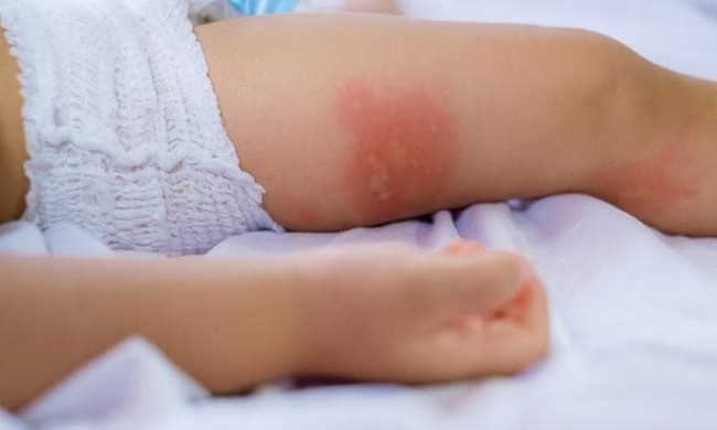 Đây chính là điều cha mẹ nên lo lắng khi con cái thường xuyên bị muỗi đốt - Ảnh 1.
