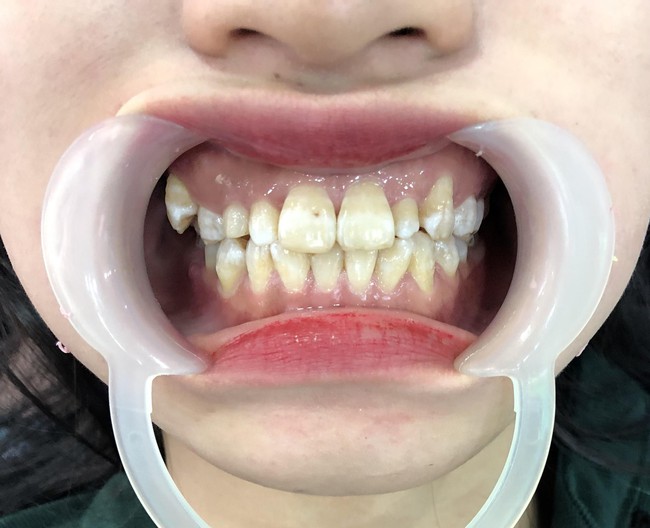 Bị gia đ&igrave;nh người y&ecirc;u phản đối chỉ v&igrave; h&agrave;m răng - Ảnh 1.