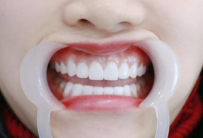 Bị gia đ&igrave;nh người y&ecirc;u phản đối chỉ v&igrave; h&agrave;m răng - Ảnh 4.