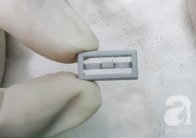 Bé trai 8 tuổi suýt tắc phổi tử vong chỉ vì vô tình nuốt phải thứ đồ chơi quen thuộc này vào bụng - Ảnh 3. Bé trai 8 tuổi suýt tắc phổi tử vong chỉ vì vô tình nuốt phải thứ đồ chơi quen thuộc này vào bụng - Ảnh 3.