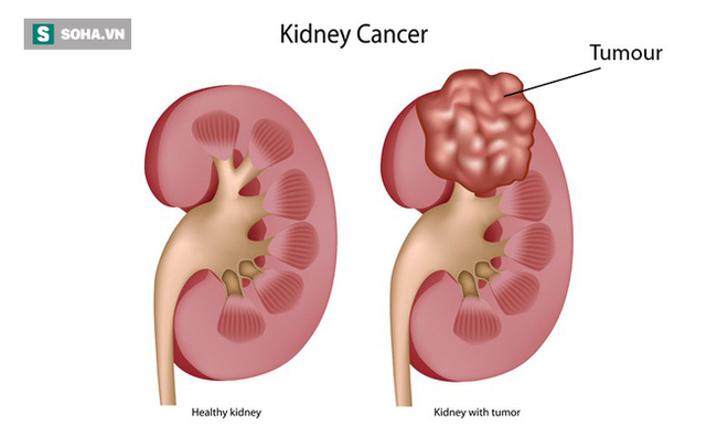 4 yếu tố chủ yếu có thể dẫn đến ung thư thận: Bất kỳ lứa tuổi nào cũng nên biết để tránh - Ảnh 2.