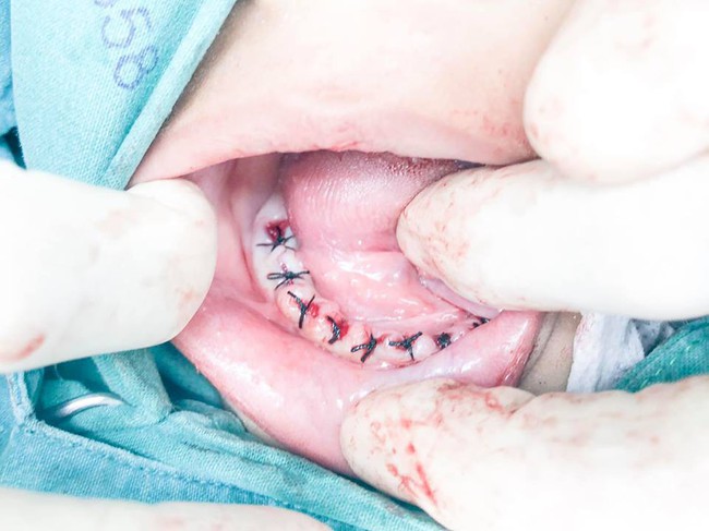 Lặp đi lặp lại thói quen tai hại này mỗi ngày, bố mẹ khiến đứa con 4 tuổi mất đi toàn bộ 18 chiếc răng - Ảnh 3.