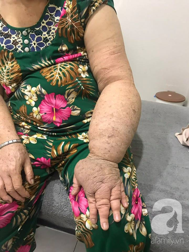 Hạnh phúc ngập tràn của người phụ nữ 15 năm mang cánh tay voi và phải cắt ngực trị ung thư vú - Ảnh 2. Hạnh phúc ngập tràn của người phụ nữ 15 năm mang cánh tay voi và phải cắt ngực trị ung thư vú - Ảnh 2.