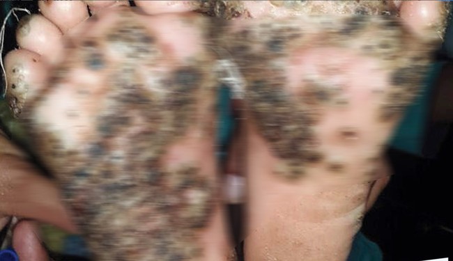 Bị bọ chét đào hang đẻ trứng trên da, bàn chân bé gái 10 tuổi biến dạng kinh dị - Ảnh 1.