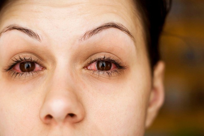 Đau mắt đỏ: Bệnh dễ gặp khi thời tiết sắp chuyển sang nóng bức - Ảnh 3.