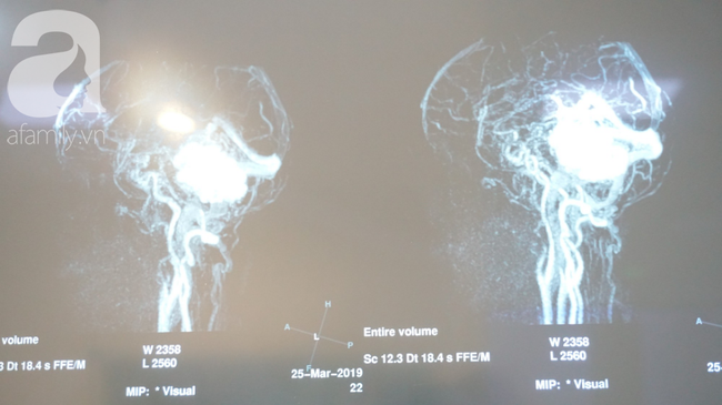15 giờ phẫu thuật ngoạn mục cứu nữ bệnh nhân mang khối u não khổng lồ, nhiều bệnh viện đã chê - Ảnh 1.