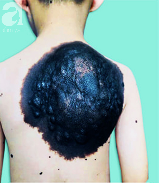 Bé trai 7 tuổi ở Vĩnh Long mang khối u khổng lồ hiếm gặp vùng lưng như chiếc mai rùa - Ảnh 1.