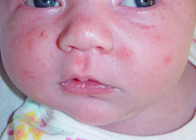 8 căn bệnh về da phổ biến trẻ sơ sinh nào cũng dễ mắc, các mẹ đang nuôi con nhỏ nên lưu ý - Ảnh 3.