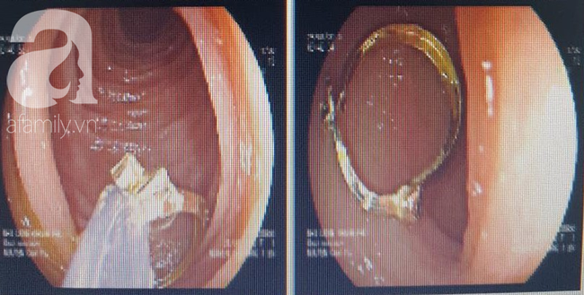 Giật khuyên tai từ bạn nuốt vào họng, bé gái 1 tuổi suýt chết vì tổn thương dạ dày - Ảnh 2.