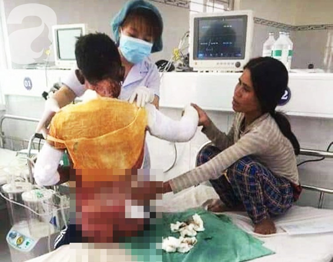 Thương tâm: Vợ chồng nghèo Gia Lai bất lực nhìn bé trai 14 tuổi nguy kịch vì bỏng xăng ngoài rẫy - Ảnh 3. Thương tâm: Vợ chồng nghèo Gia Lai bất lực nhìn bé trai 14 tuổi nguy kịch vì bỏng xăng ngoài rẫy - Ảnh 3.