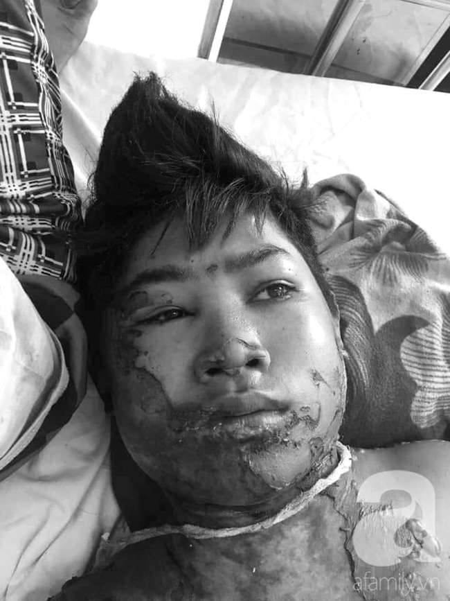 Thương tâm: Vợ chồng nghèo Gia Lai bất lực nhìn bé trai 14 tuổi nguy kịch vì bỏng xăng ngoài rẫy - Ảnh 1. Thương tâm: Vợ chồng nghèo Gia Lai bất lực nhìn bé trai 14 tuổi nguy kịch vì bỏng xăng ngoài rẫy - Ảnh 1.
