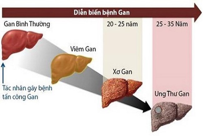 Sư tử Kim Loan - học trò của cố nghệ sĩ Trần Lập qua đời vì ung thư gan: Dấu hiệu nhận biết căn bệnh gây tử vong cao này - Ảnh 5.