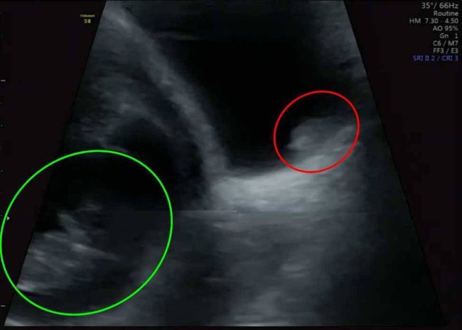 Đang mang bầu thì đột ngột phát hiện vật thể lạ trong bụng, bà mẹ không ngờ mình được cứu mạng nhờ một lần siêu âm thai - Ảnh 1.