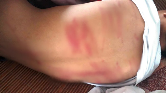 Vụ nam sinh lớp 8 bị bố đánh dã man phải nhập viện: Vợ cũ tố chồng cũng từng mình đánh gãy tay và dọa giết - Ảnh 1. Vụ nam sinh lớp 8 bị bố đánh dã man phải nhập viện: Vợ cũ tố chồng cũng từng mình đánh gãy tay và dọa giết - Ảnh 1.