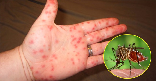 Chuyên gia cảnh báo: Cẩn trọng bệnh sốt xuất huyết đang có xu hướng tăng mạnh - Ảnh 1.