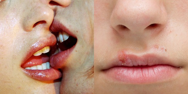 Cảnh báo: Kiểu hôn lãng mạn cặp đôi nào cũng đã thử qua có thể là nguyên nhân khiến bạn lây bệnh lậu ở cổ họng - Ảnh 2.