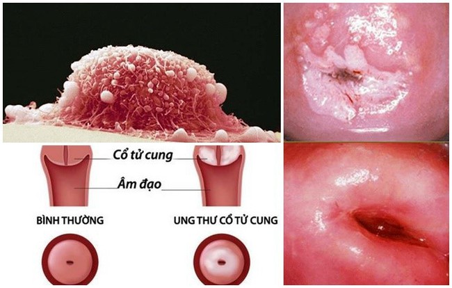 Phụ nữ quan hệ tình dục với 5 người trở lên dễ mắc ung thư hơn: BS chỉ đích danh thủ phạm - Ảnh 1.