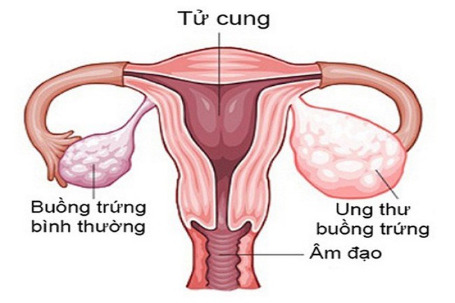 Bé gái 14 tuổi bụng to bất thường, đi khám phát hiện bệnh ung thư hiếm gặp và tử vong sau 1 năm, bác sĩ khuyên cha mẹ cần chú ý bộ phận này của con - Ảnh 1.