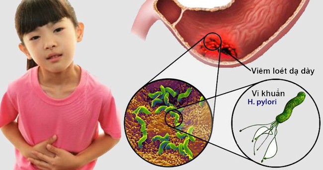 Bác sĩ cảnh báo ngày càng nhiều trẻ em bị thủng, loét dạ dày vì thói quen ăn uống tưởng chừng vô hại mà cha mẹ vẫn để con làm - Ảnh 2.