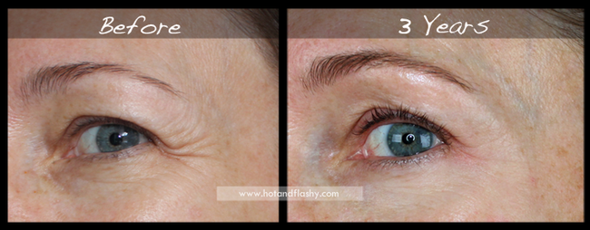 Đắn đo trước hiệu quả chống già của retinol? Minh chứng người phụ nữ sau 3 năm kiên trì với làn da như photoshop sẽ khiến bạn thay đổi - Ảnh 4.