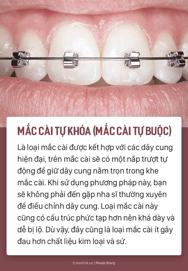 Chỉ là niềng răng thôi mà cũng có rất nhiều phương pháp, loại hình khác nhau để các bạn lựa chọn - Ảnh 5.