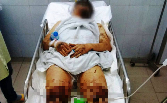 Nhận dạng nghi phạm tạt axit, cắt đứt gân chân nam Việt kiều: Người gầy, nói giọng Bắc - Ảnh 1.