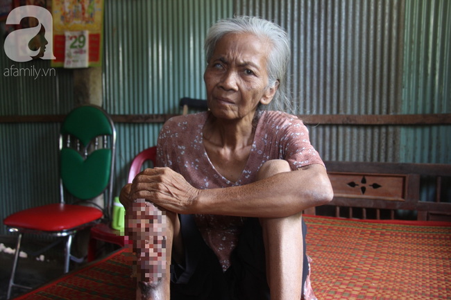 Hi vọng đến với người bà 70 tuổi mù một bên mắt, chân bị hoại tử, thối rữa nặng khi được mọi người giúp đỡ - Ảnh 1.