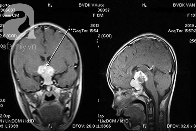Bé gái 3 năm không tăng cân, suy kiệt vì khối u não nhưng gia đình không đưa đi khám vì nghĩ... ham chơi - Ảnh 1.