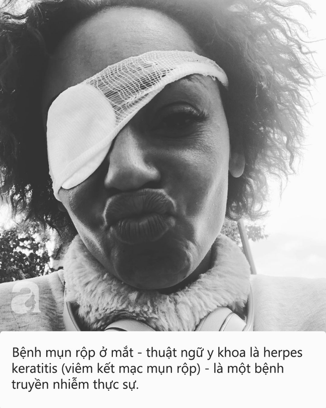 Đây là căn bệnh do virus herpes gây ra khiến cựu thành viên nhóm nhạc Spice Girl suýt mù lòa - Ảnh 1. Đây là căn bệnh do virus herpes gây ra khiến cựu thành viên nhóm nhạc Spice Girl suýt mù lòa - Ảnh 1.