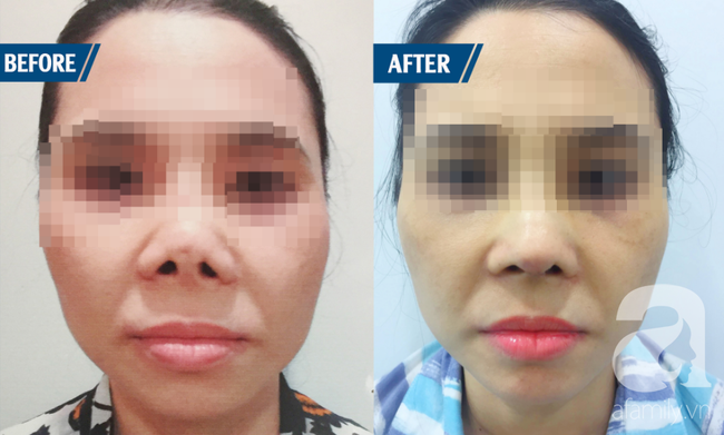 Ham nâng mũi cao Tây bất chấp, nhiều phụ nữ Việt gánh hậu quả nặng nề - Ảnh 5. Ham nâng mũi cao Tây bất chấp, nhiều phụ nữ Việt gánh hậu quả nặng nề - Ảnh 5.